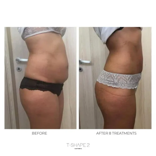 116752-t-shape-2-Abdomen-after-8-txt-c4.jpg
