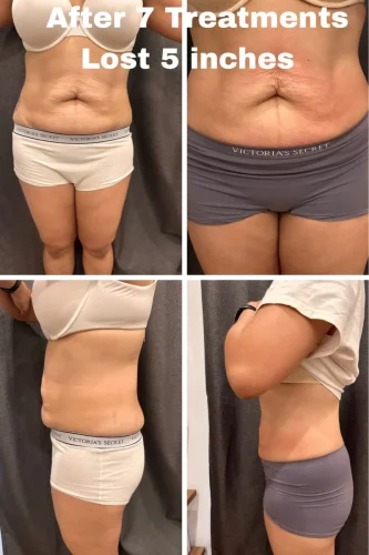 116753-waist-and-abd-After-7-Treatments-c8.png