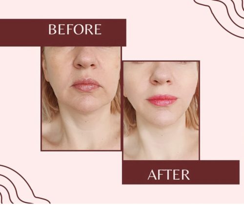 81539-botox-before-and-after