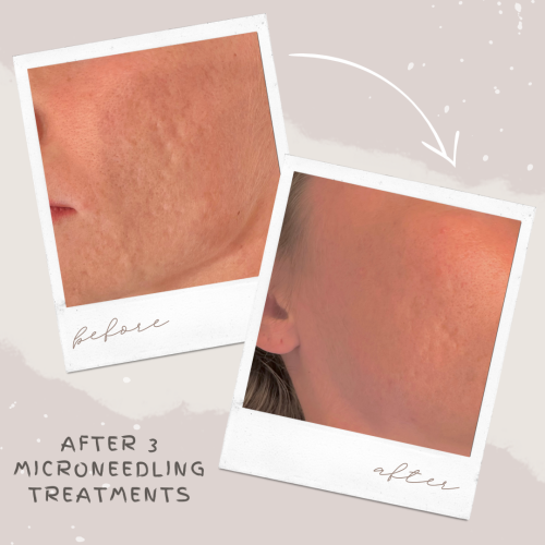 83298-Microneedling-before-and-after