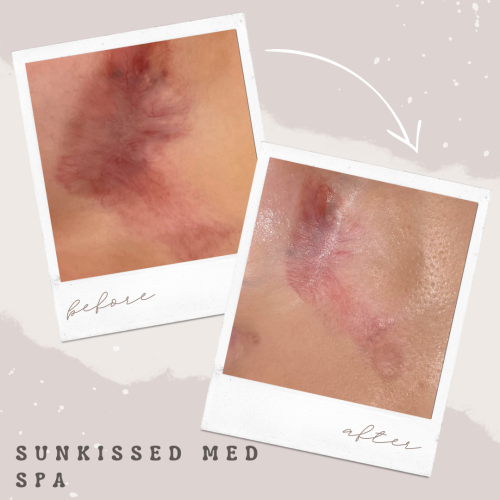 88126-MN-Before-and-After-thrid-degree-burn